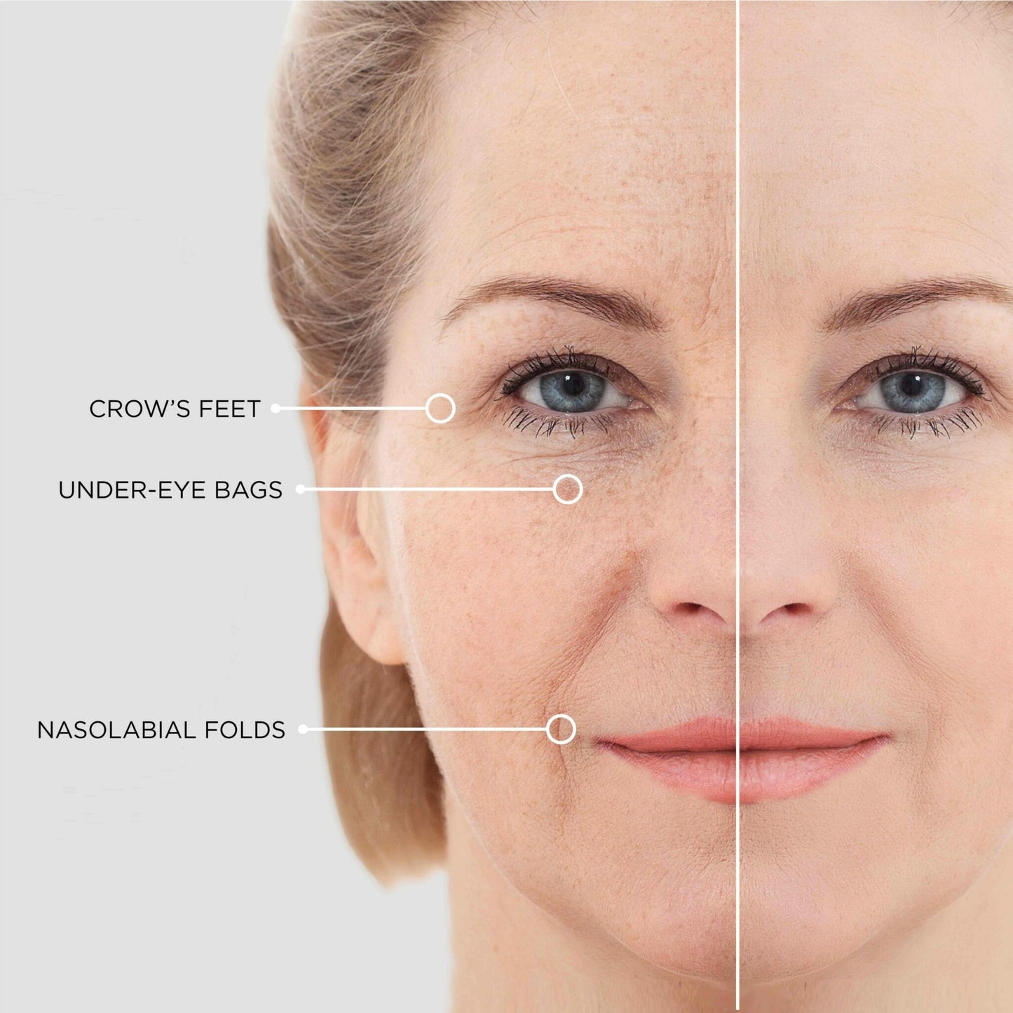 Infused Microneedle Skin Patches