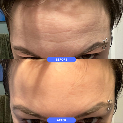 SilkLift Pro™