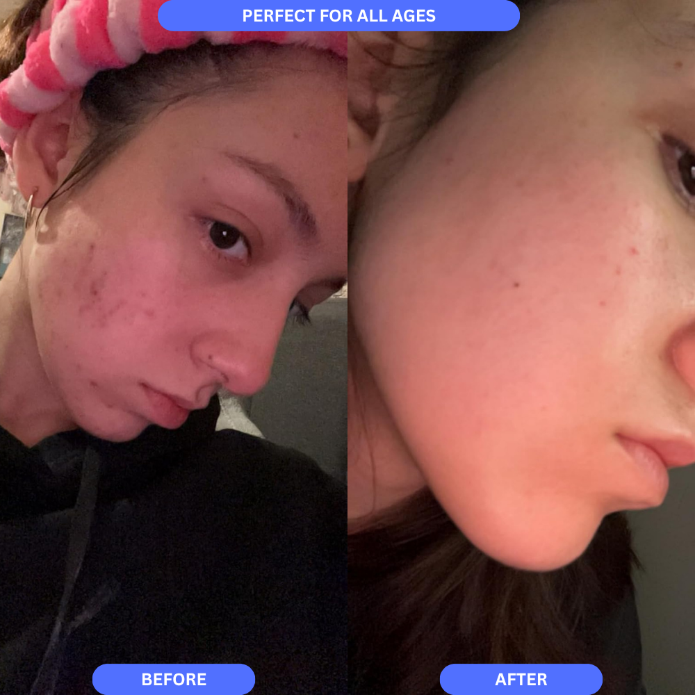 Scarheal Pro™