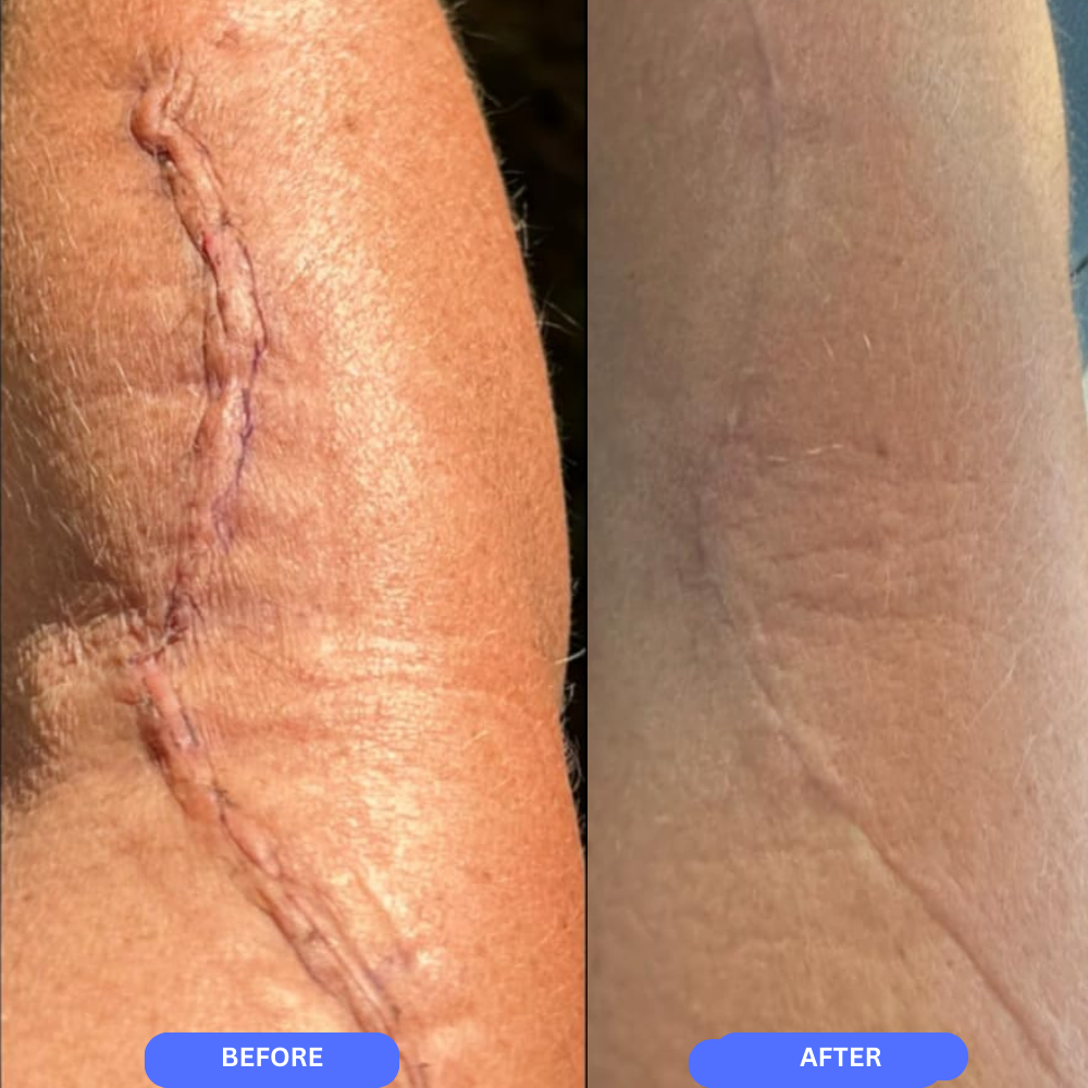 Scarheal Pro™